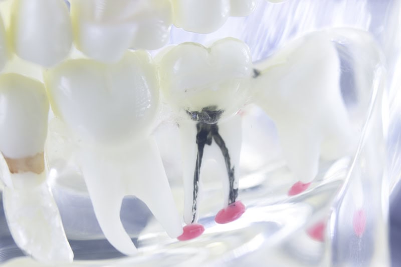 Root canal treatment Pearl River